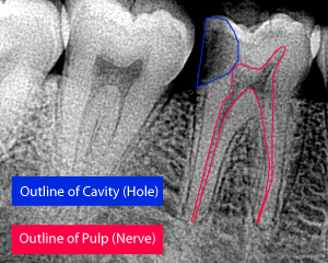 caries.46.befor.outlines