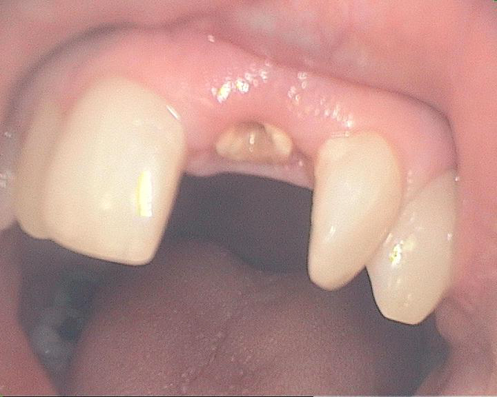 Dental Case Study Front Tooth Broken To Gum Line Restore With Crown   Post.core2  