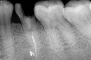 Un-restorable tooth