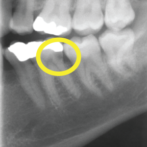 X-ray with cavity circled