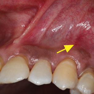 Draining fistula on a necrotic tooth. Edmonton Dentist. Summerlea Dental