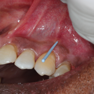 Dental Case Study: Odd Case For Root Canal