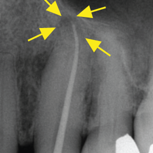 Xray showing the blue gutta percha in the fistula. It ends at the tip of the root where there is an abscess forming.