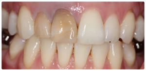 Dental Case Study: Crowning Dark Teeth After Trauma and Root Canal