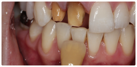 Take a shade of the prepared tooth (stump shade)
